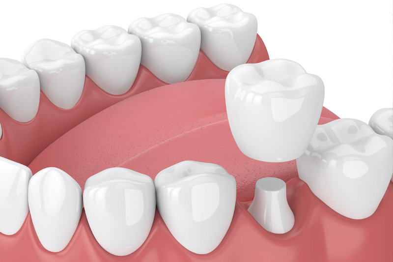 Dental Crowns in Fernley
