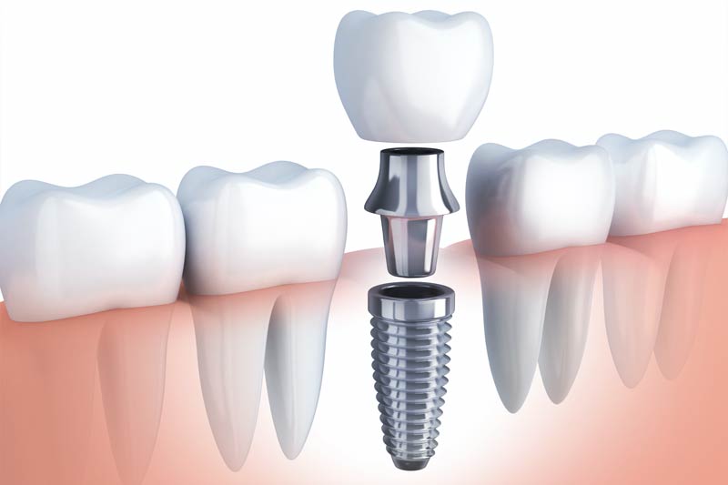 Dental Treatments in Fernley